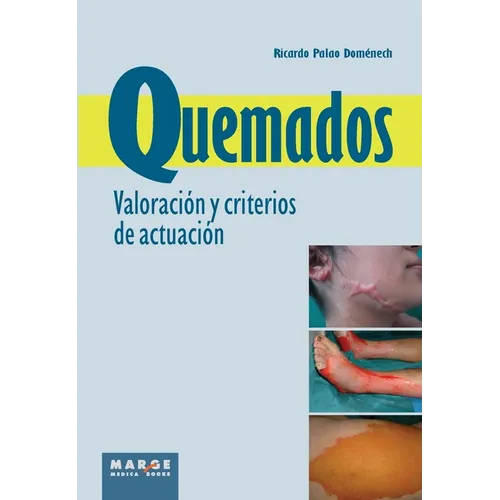 Quemados. Valoración y criterios de actuación - Paperback